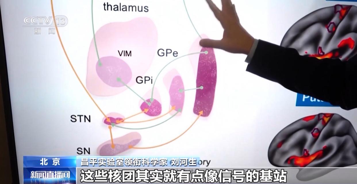 帕金森病治疗有新突破！中国科研团队发现核心致病环路