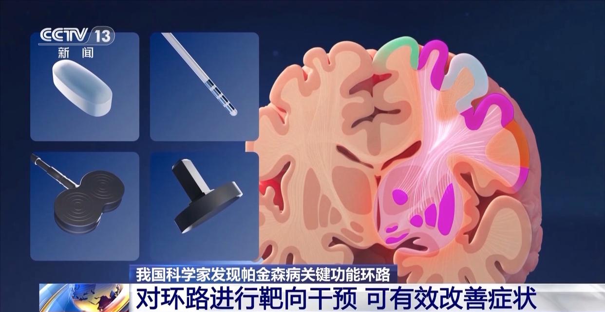 帕金森病治疗有新突破！中国科研团队发现核心致病环路