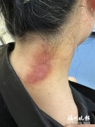 湖南各大医院黄牛挂号电话遇到隐翅虫千万别用手拍 专家称其毒液堪比硫酸